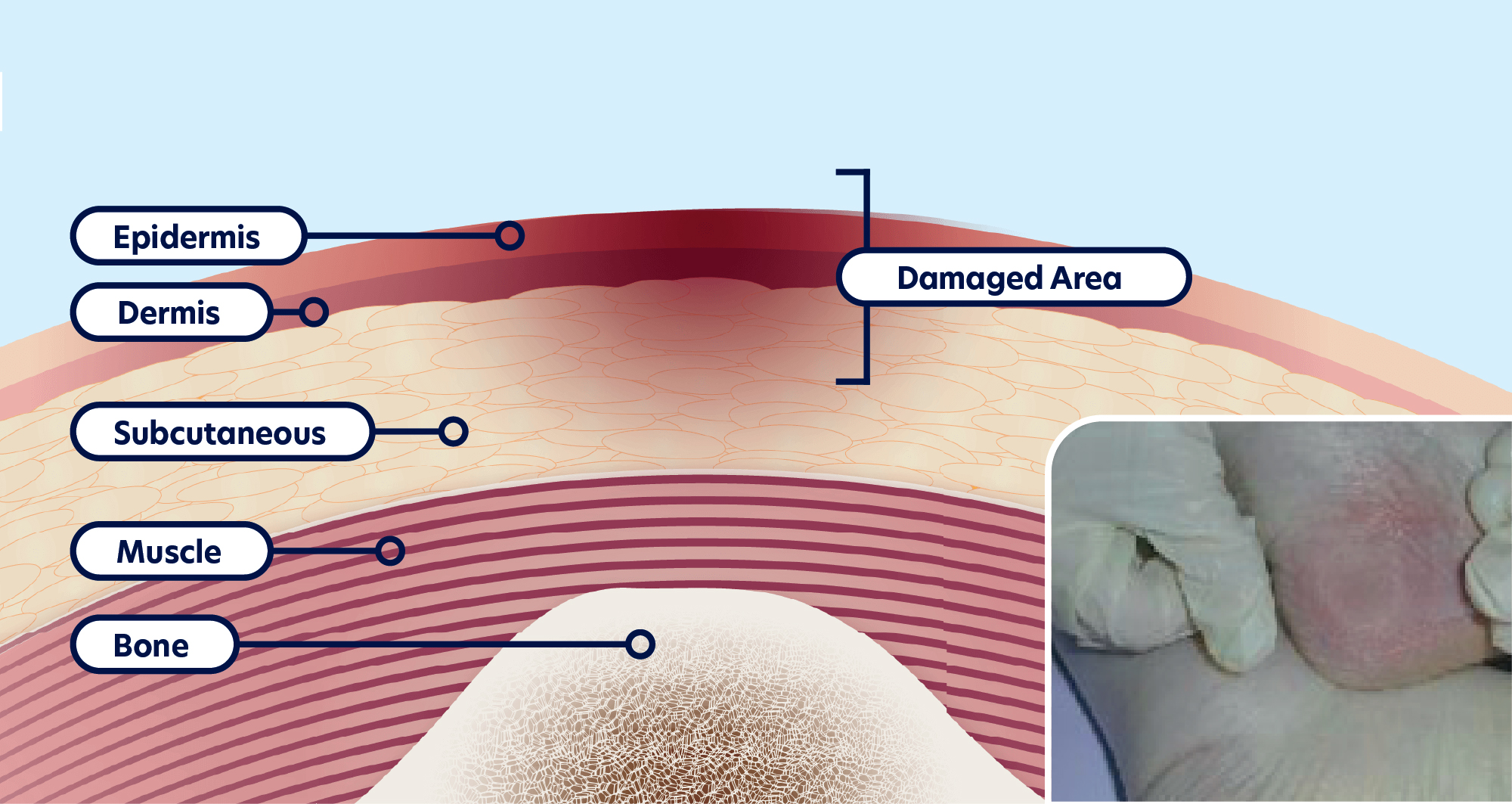 EPUAP Pressure Ulcer Classification 2019 – Part 1 | ActivHeal® Academy