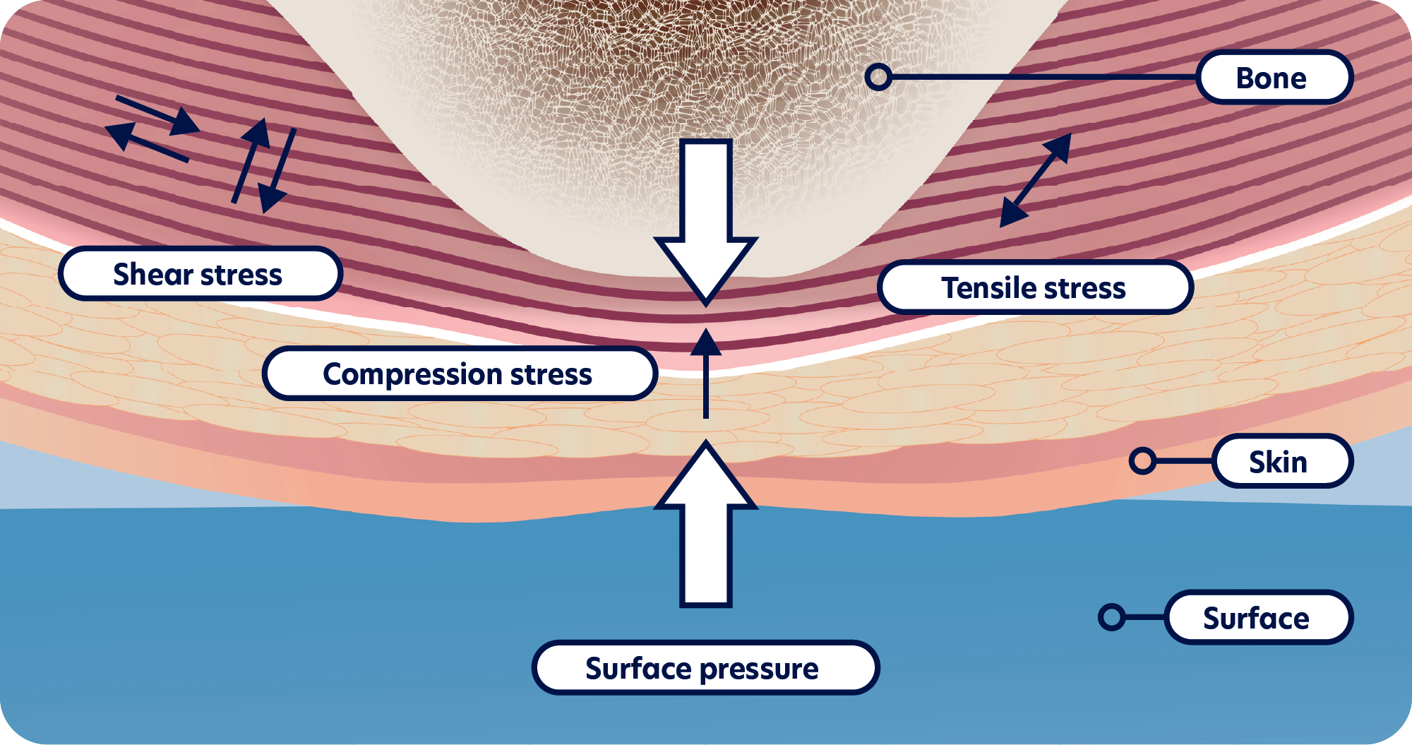 What Is A Pressure Ulcer/Injury? ActivHeal® Academy